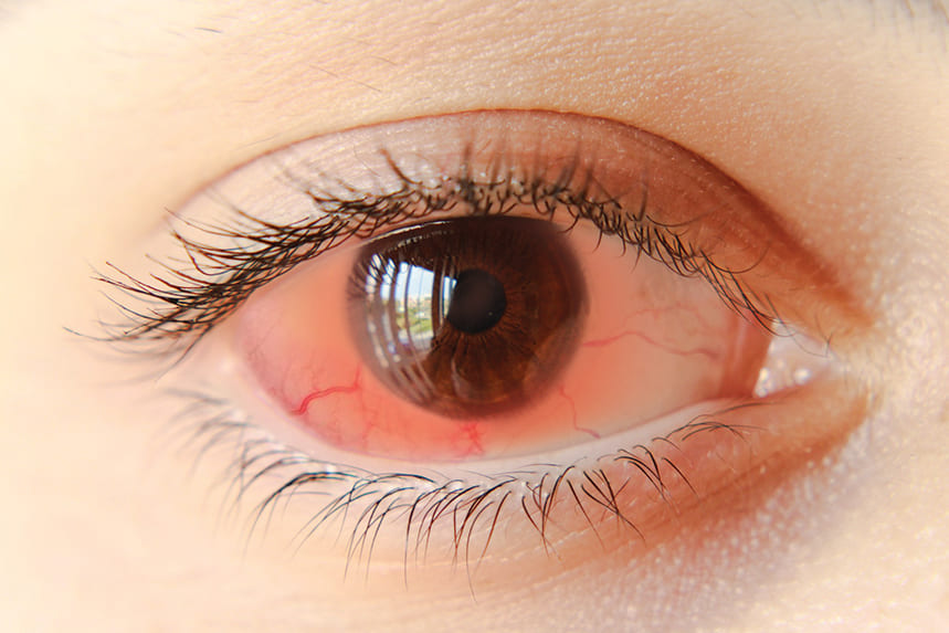 La Sécheresse Oculaire Optique Santé